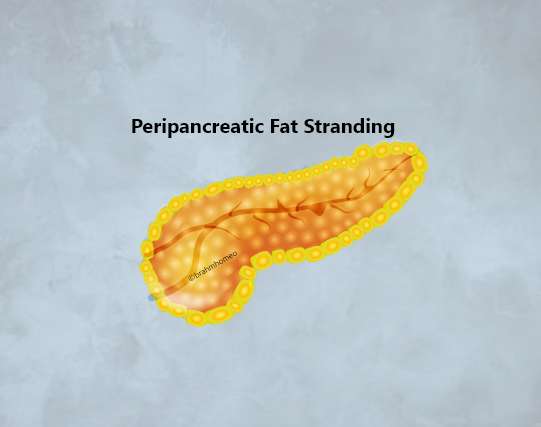 Peripancreatic Fat Stranding